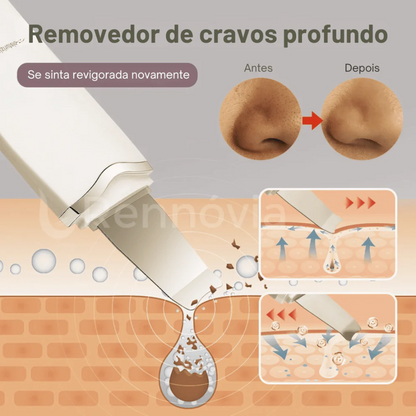 Removedor De Cravos e Limpeza de Pele- Peeling Ultrassonico